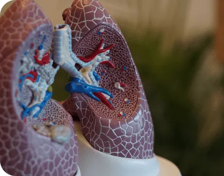 Medical model of lungs demonstrating interstitial lung disease