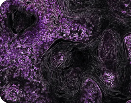 Illustration of a diseased lung affected by lung cancer