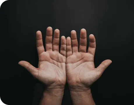 Close-up of sweating hands associated with palmar hyperhidrosis